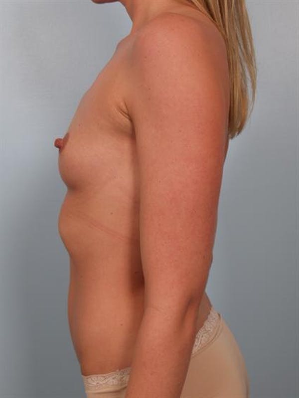 Breast Augmentation Before & After Gallery - Patient 1310626 - Image 5