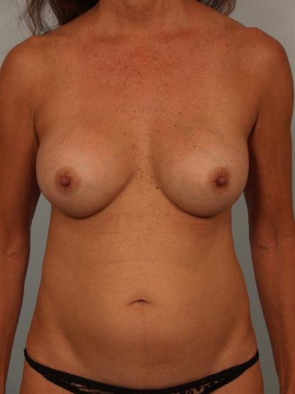 before image of Breast Implant with Fat Grafting in Beverly Hills by Dr. Cohen.