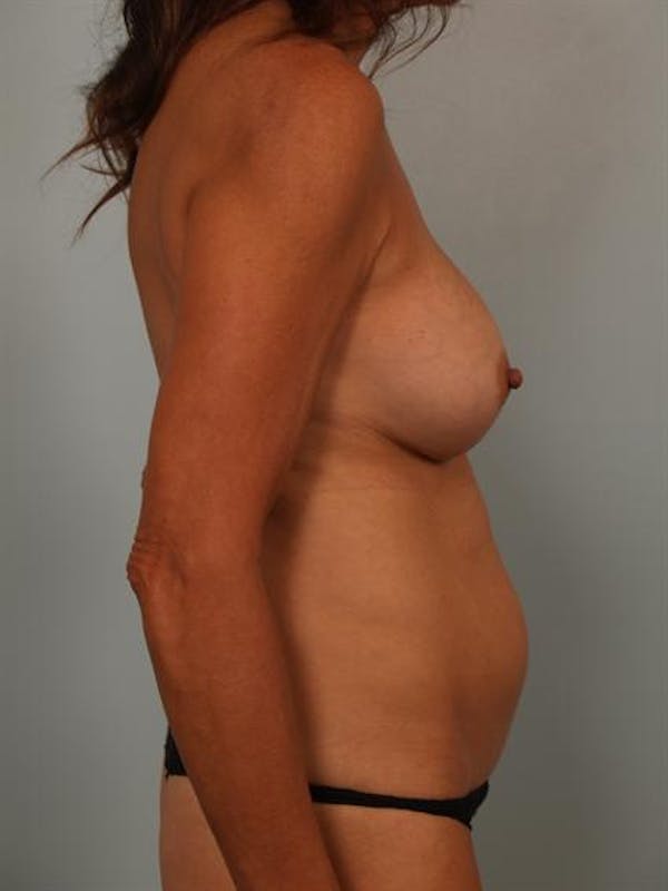 Fat Grafting Before & After Gallery - Patient 1310631 - Image 3