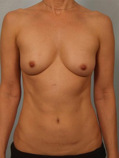 Breast Lift Before & After Gallery - Patient 1310632 - Image 1