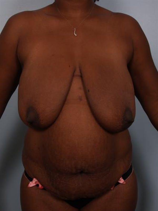 Breast Reduction Before & After Gallery - Patient 1310633 - Image 1