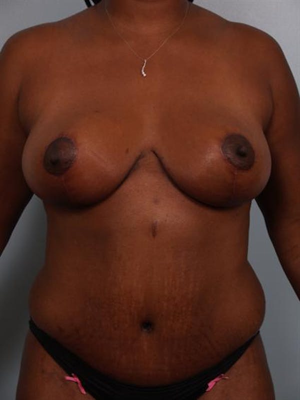 Breast Reduction Before & After Gallery - Patient 1310633 - Image 2