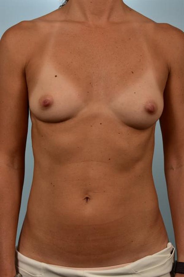 Breast Augmentation Before & After Gallery - Patient 1310637 - Image 1