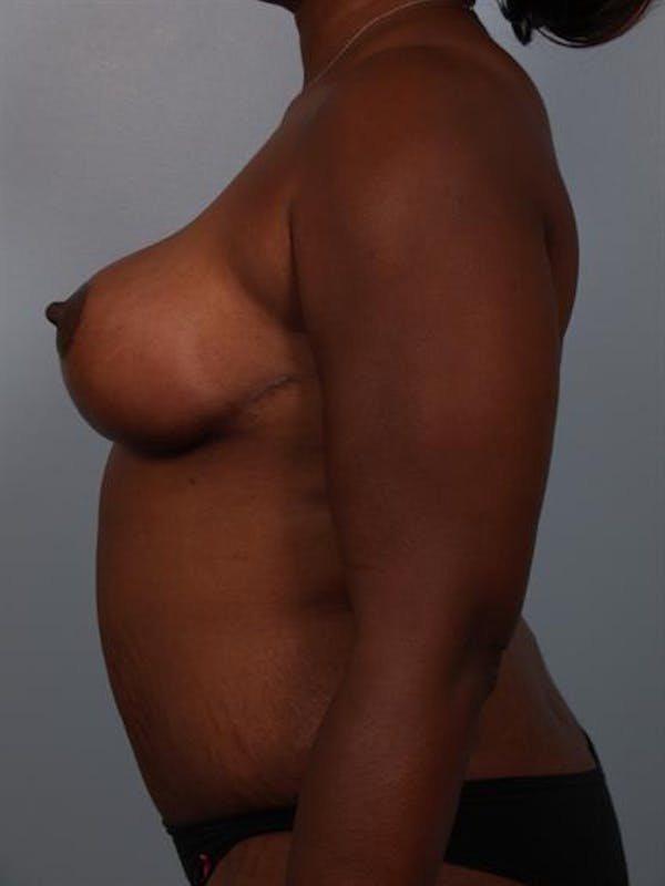 Breast Reduction Before & After Gallery - Patient 1310633 - Image 6
