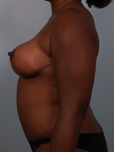 Breast Reduction Before & After Gallery - Patient 1310633 - Image 6