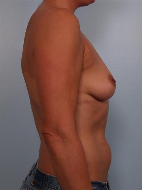 Breast Lift Before & After Gallery - Patient 1310638 - Image 3