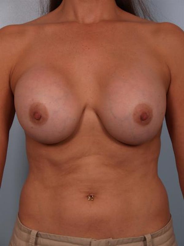 Complex Breast Revision Before & After Gallery - Patient 1310635 - Image 1