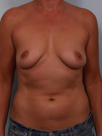 Breast Lift Before & After Gallery - Patient 1310638 - Image 1