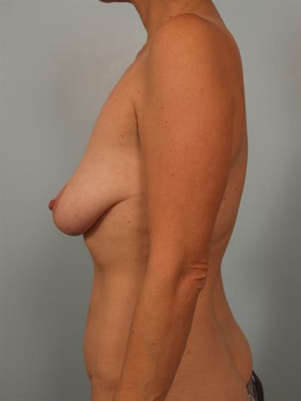 Fat Grafting Before & After Gallery - Patient 1310636 - Image 5