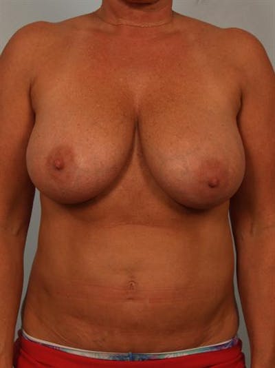 Breast Reduction Before & After Gallery - Patient 1310645 - Image 1