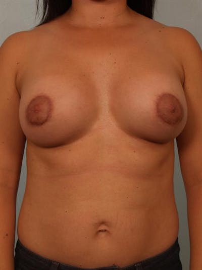 Breast Augmentation Before & After Gallery - Patient 1310644 - Image 4