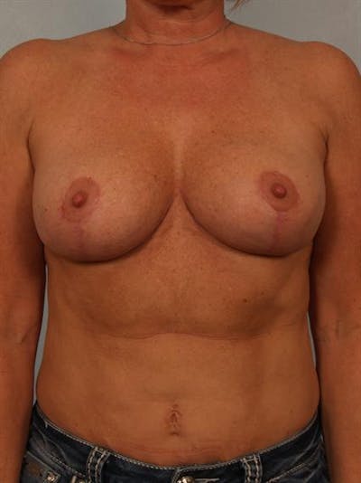 Breast Reduction Gallery - Patient 1310645 - Image 2