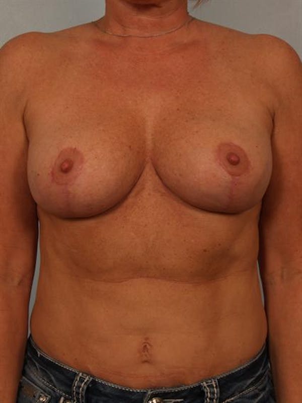 Breast Reduction Before & After Gallery - Patient 1310645 - Image 2