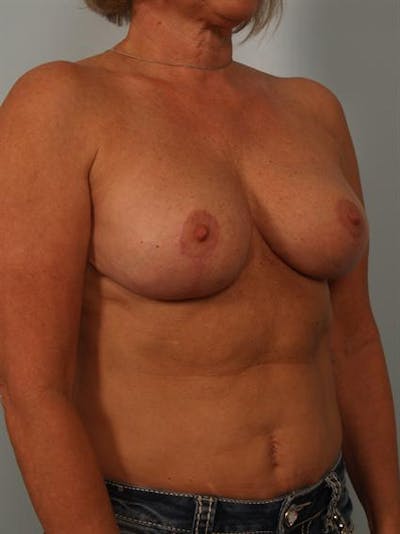 Breast Reduction Before & After Gallery - Patient 1310645 - Image 4
