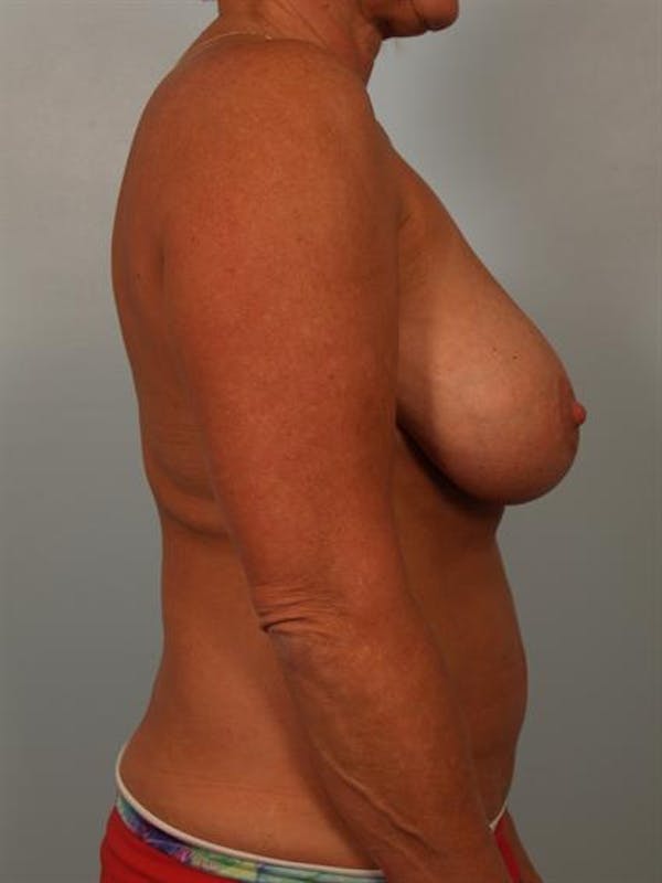 Breast Reduction Before & After Gallery - Patient 1310645 - Image 5