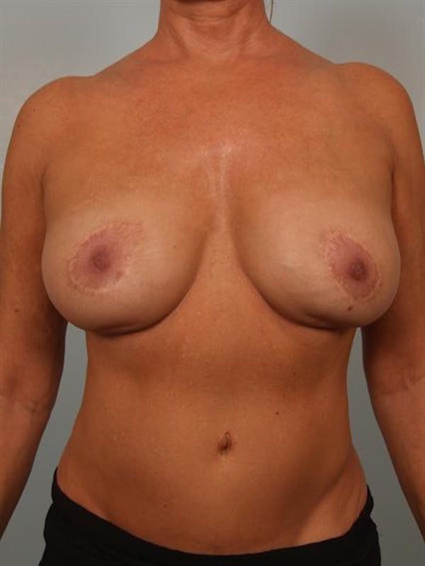 Fat Grafting Before & After Gallery - Patient 1310648 - Image 1