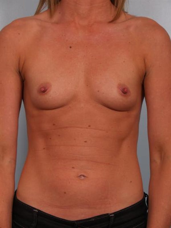 Breast Augmentation Gallery - Patient 1310652 - Image 1