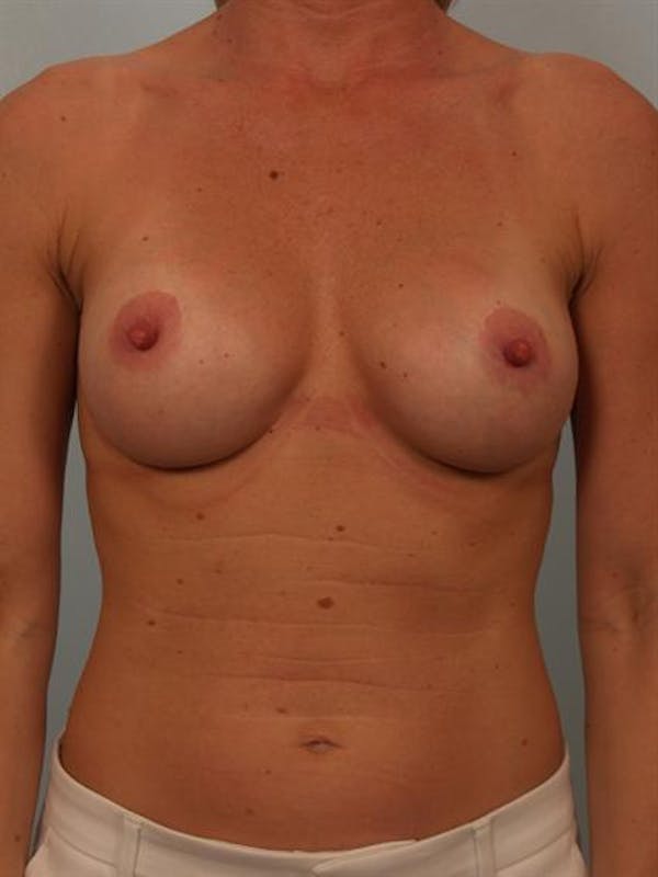 Breast Augmentation Before & After Gallery - Patient 1310652 - Image 2