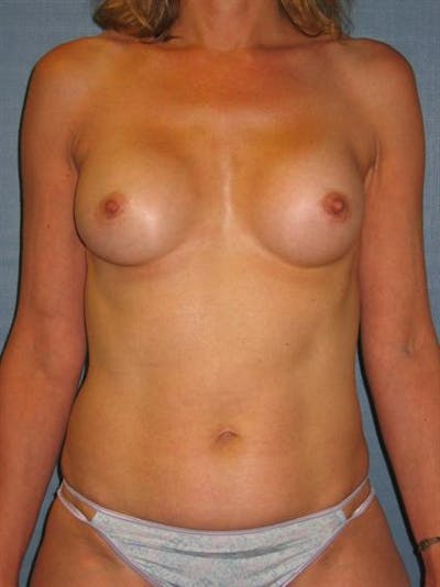 Complex Breast Revision Before & After Gallery - Patient 1310653 - Image 1