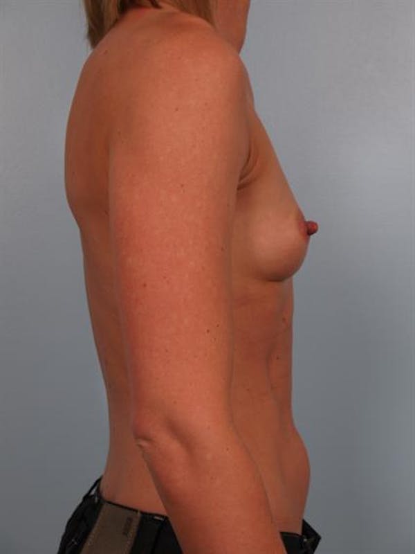 Breast Augmentation Before & After Gallery - Patient 1310652 - Image 5