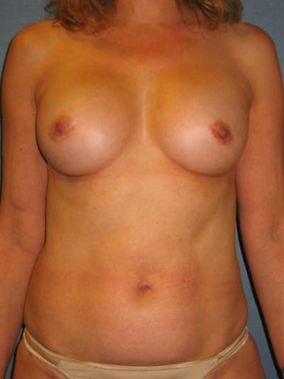 Complex Breast Revision Before & After Gallery - Patient 1310653 - Image 2