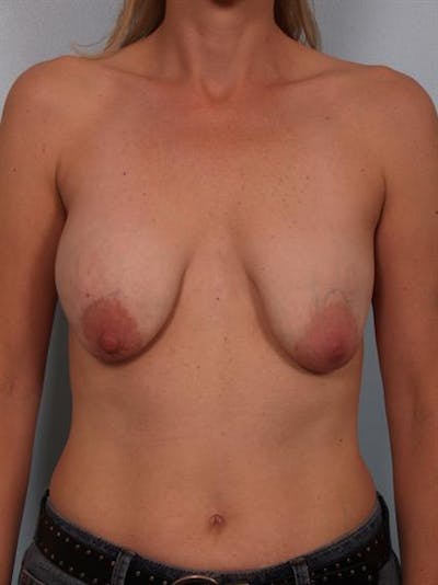 Breast Lift Before & After Gallery - Patient 1310655 - Image 1