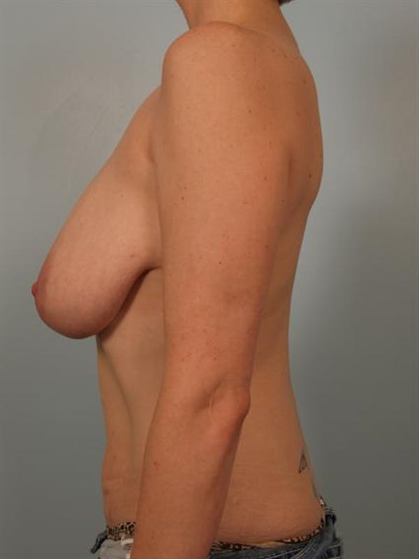 Breast Reduction Before & After Gallery - Patient 1310657 - Image 3