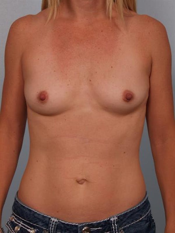 Breast Augmentation Before & After Gallery - Patient 1310660 - Image 1