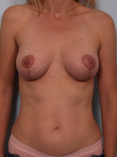 Breast Lift Before & After Gallery - Patient 1310655 - Image 2