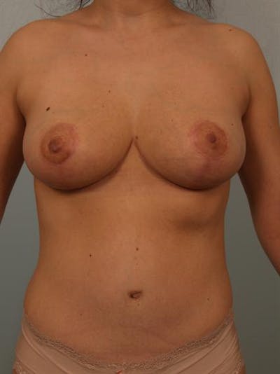 Mommy Makeover Before & After Gallery - Patient 1310656 - Image 2