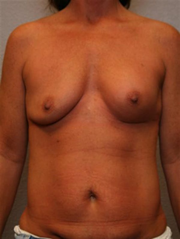 Complex Breast Revision Before & After Gallery - Patient 1310659 - Image 1