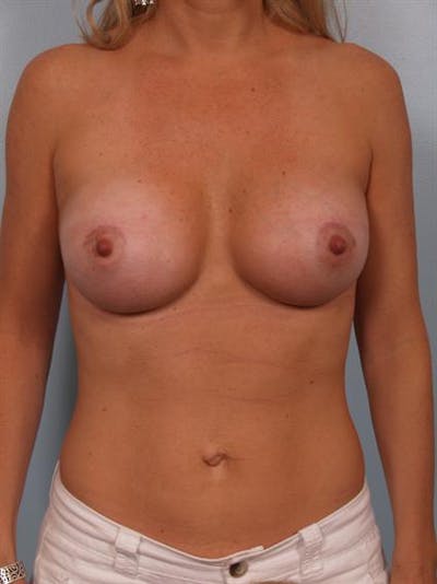 Breast Augmentation Before & After Gallery - Patient 1310660 - Image 2