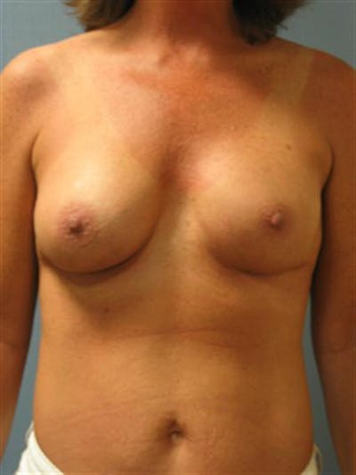 Complex Breast Revision Before & After Gallery - Patient 1310659 - Image 2