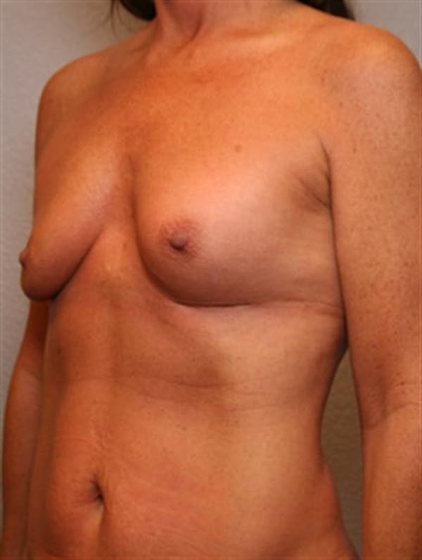 Complex Breast Revision Before & After Gallery - Patient 1310659 - Image 3