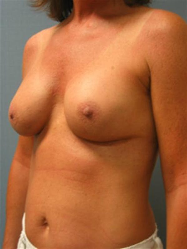 Complex Breast Revision Before & After Gallery - Patient 1310659 - Image 4