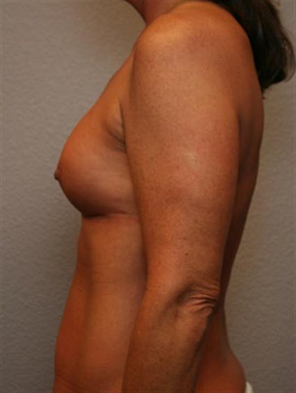 Complex Breast Revision Before & After Gallery - Patient 1310659 - Image 5