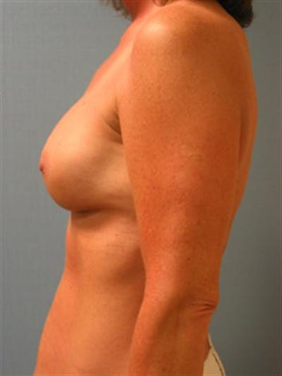 Complex Breast Revision Gallery - Patient 1310659 - Image 6