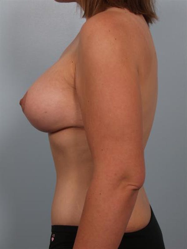 Breast Lift Before & After Gallery - Patient 1310661 - Image 4