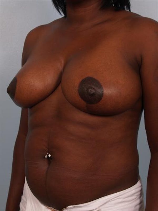Breast Reduction Before & After Gallery - Patient 1310663 - Image 4