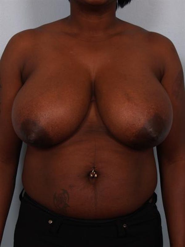 Breast Reduction Before & After Gallery - Patient 1310663 - Image 1