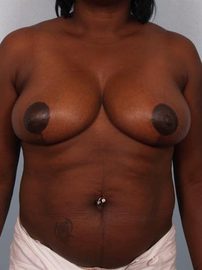 Breast Reduction Gallery - Patient 1310663 - Image 2