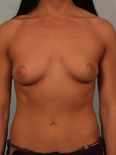 Breast Augmentation Before & After Gallery - Patient 1310667 - Image 1