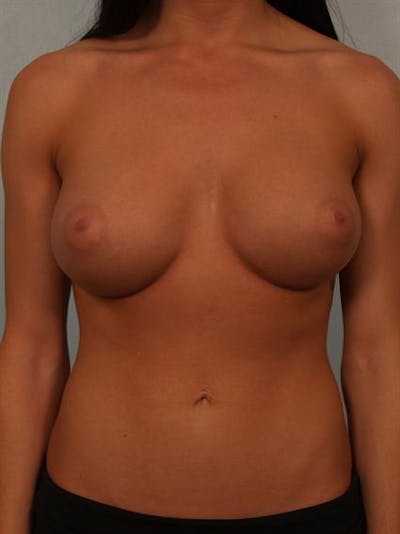 Breast Augmentation Before & After Gallery - Patient 1310667 - Image 2