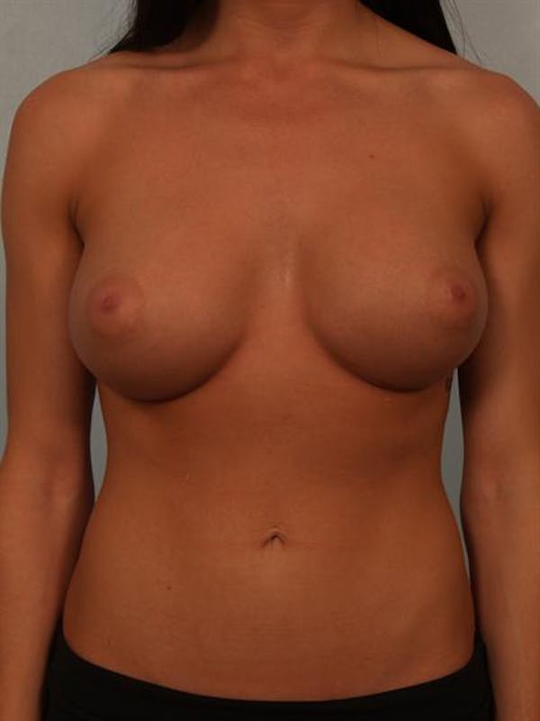 Breast Augmentation Gallery - Patient 1310667 - Image 2