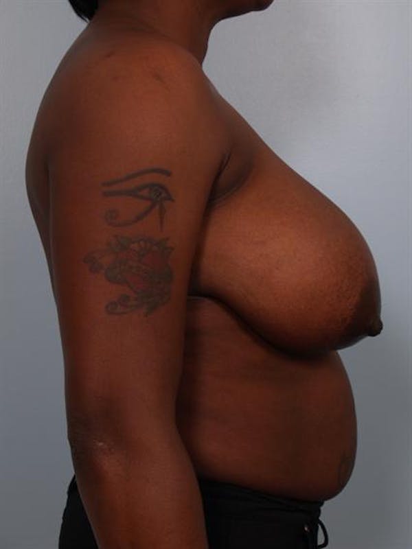 Breast Reduction Before & After Gallery - Patient 1310663 - Image 5