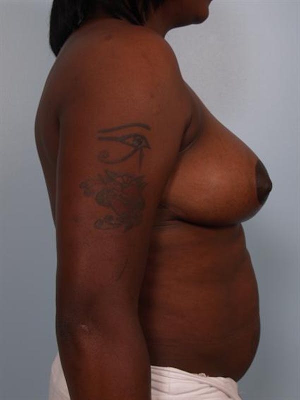 Breast Reduction Before & After Gallery - Patient 1310663 - Image 6