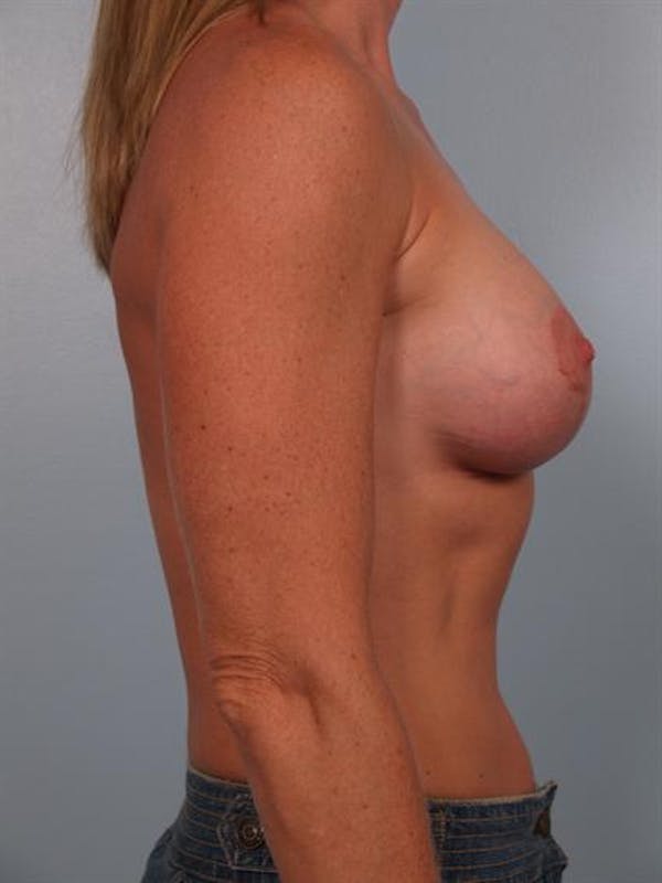 Breast Lift Before & After Gallery - Patient 1310669 - Image 4