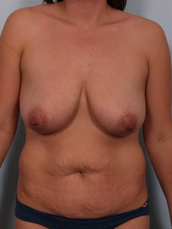 Breast Reduction Before & After Gallery - Patient 1310671 - Image 1