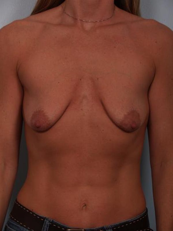 Breast Lift Gallery - Patient 1310669 - Image 1