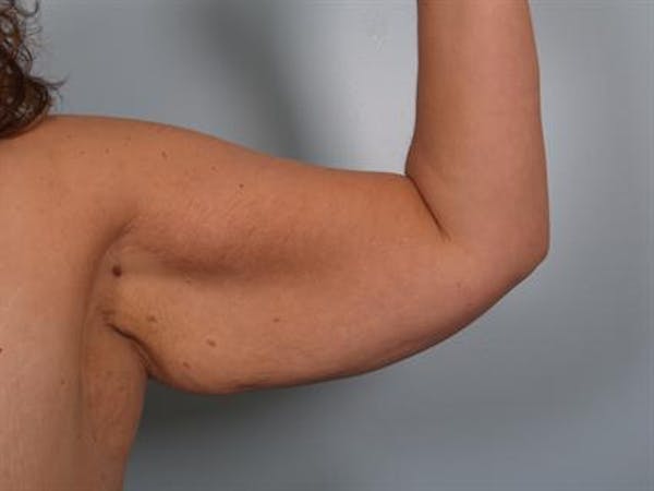 Brachioplasty (Arm Lift) Before & After Gallery - Patient 1310666 - Image 3